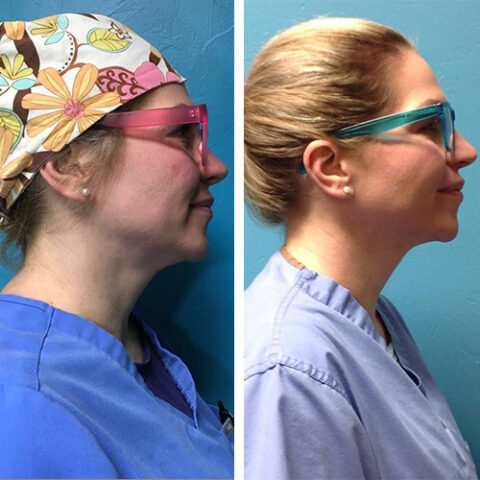 kybella before and after