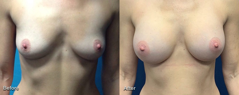 Breast Augmentation front view case 55